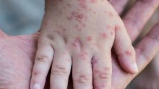 جهود وطنية للسيطرة على داء الحصبة في المغرب