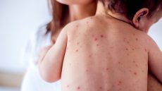 وزارة الصحة اعتمدت خطة متعددة المحاور للحد من انتشار “بوحمرون”