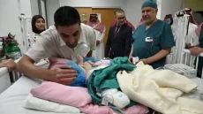 نجاح عملية فصل التوأم المغربي «سجى وضحى» في الرياض